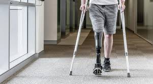 Cobertura de Próteses e Órteses pelos Planos de Saúde: Quais São os Seus Direitos?