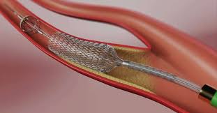 Cobertura da Cirurgia de Redução de Risco Circulatório (Endarterectomia de Carótida) pelos Planos de Saúde